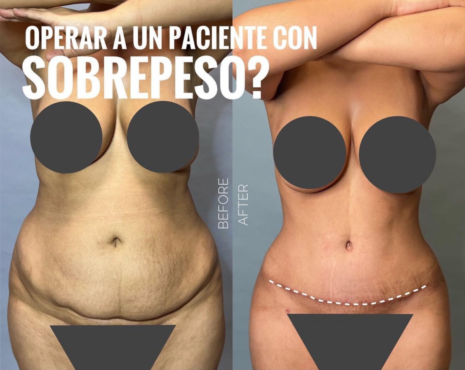 Imagen referencial de dermolipectomía: comparación antes y después